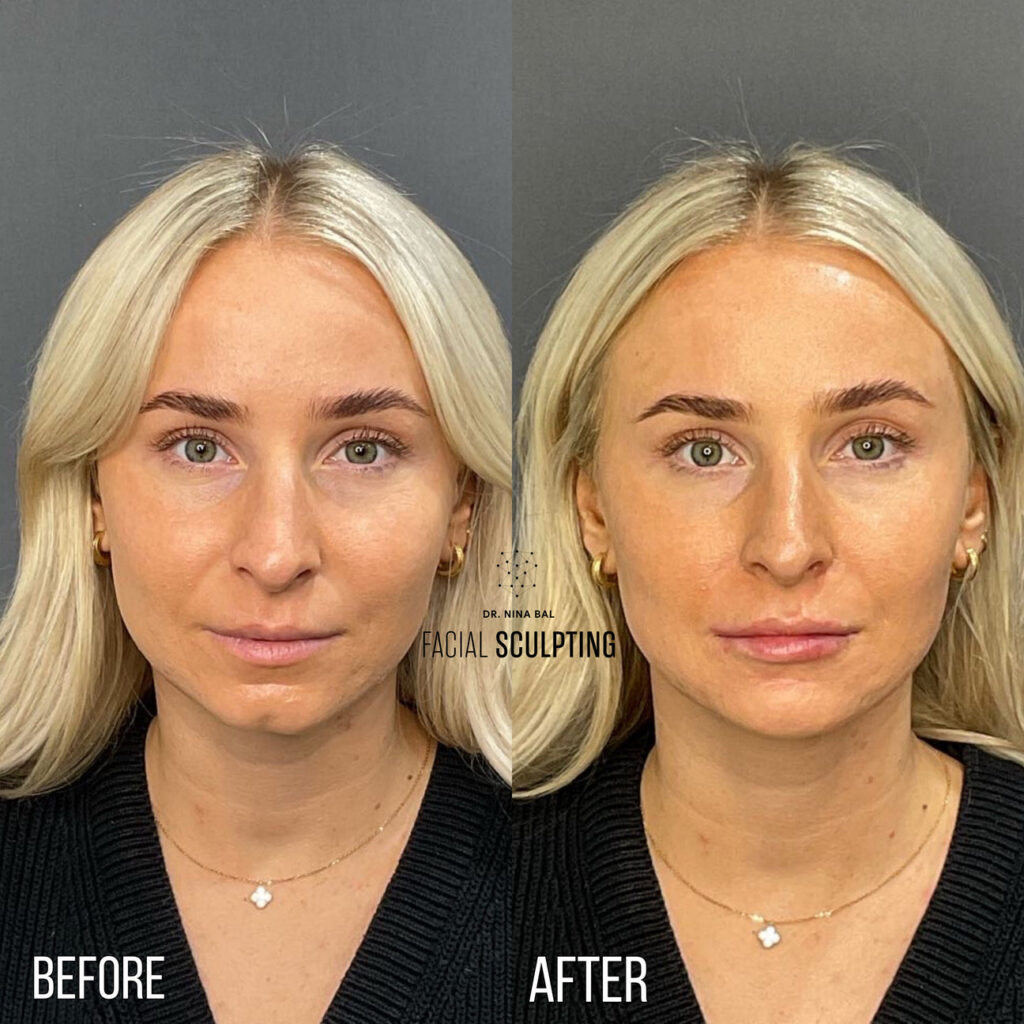 Cheek OR Jawline OR Chin Sculpting 1ml's Review Image