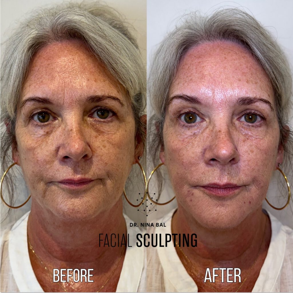 Marionette Lines / Chin Shadows 1ml's Review Image