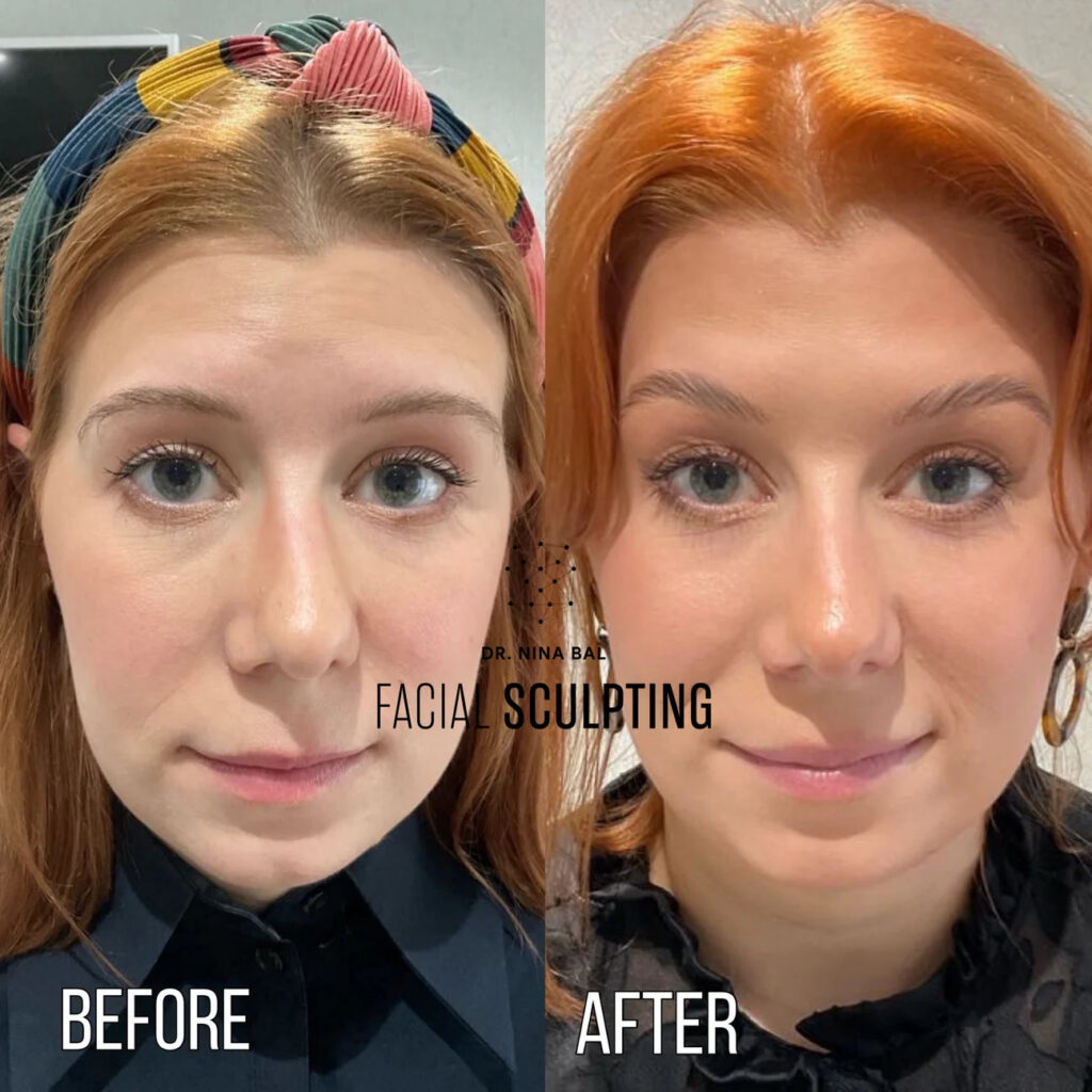 Anti-wrinkle Injections / Brows Lift's Review Image