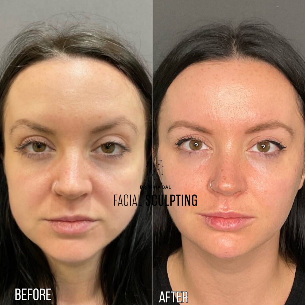 Endolift®'s Review Image