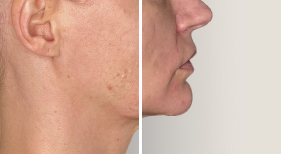 JULÄINE™ Bio-Stimulator Treatment treatment stage 0 Bio-stimulation