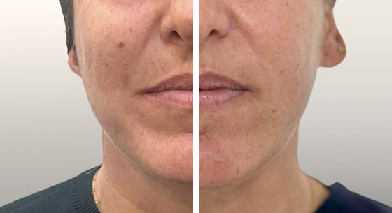 JULÄINE™ Bio-Stimulator Treatment treatment stage 1 Natural production