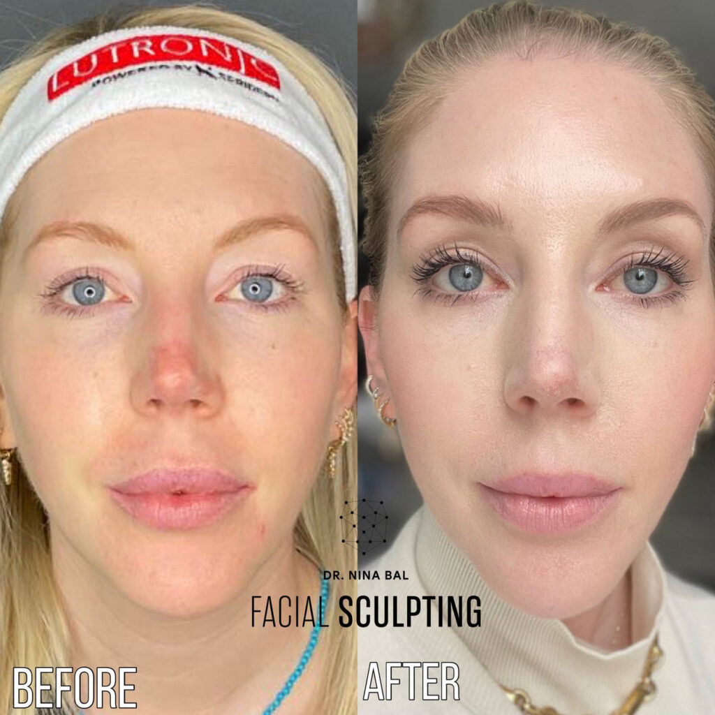 Lutronic LaseMD Ultra Thulium Laser (FACE)'s Review Image